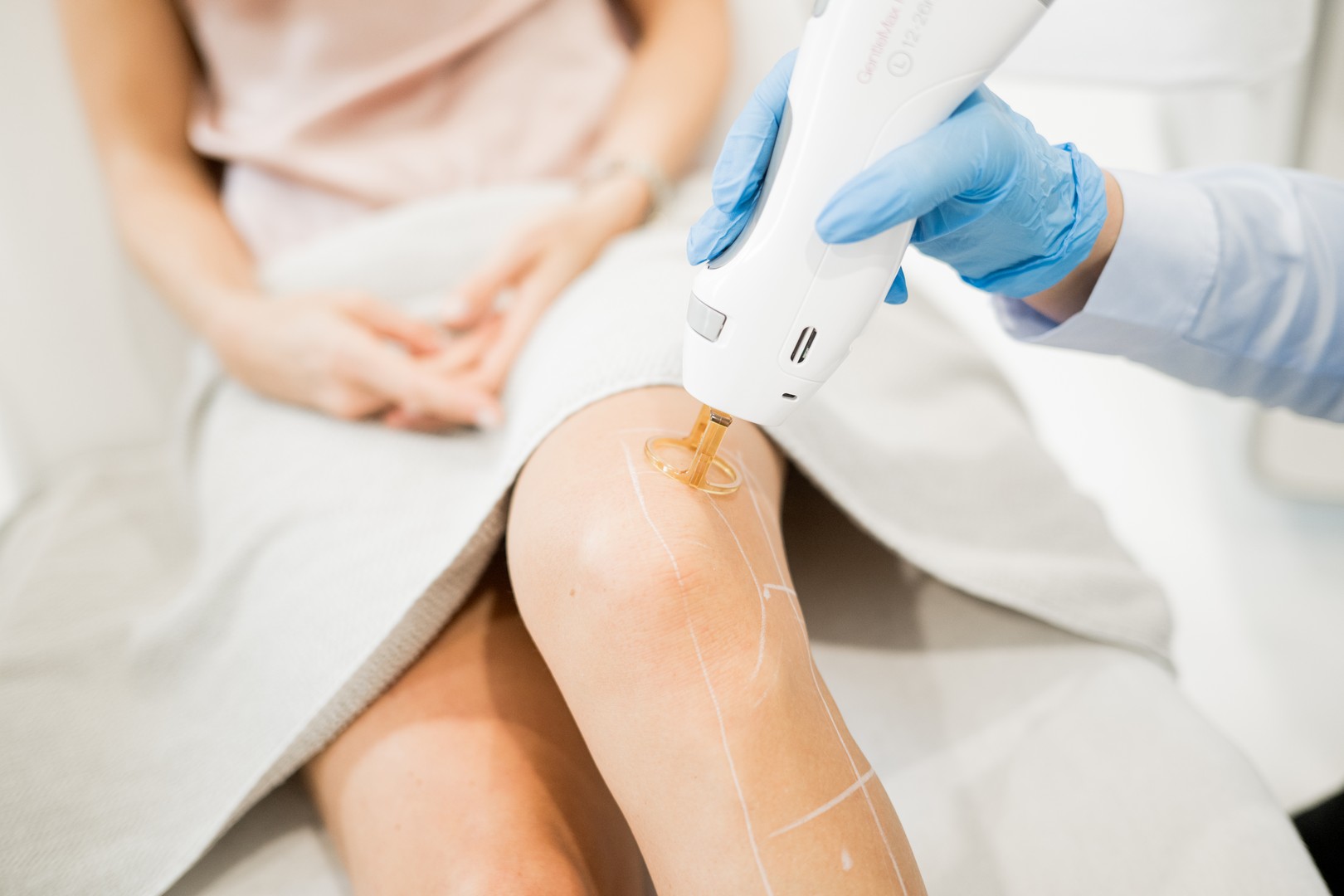 Berger_Laserhaarentfernung_Laser_wax_Rasierpickel_Regensburg_haarentfernung_dauerhaft